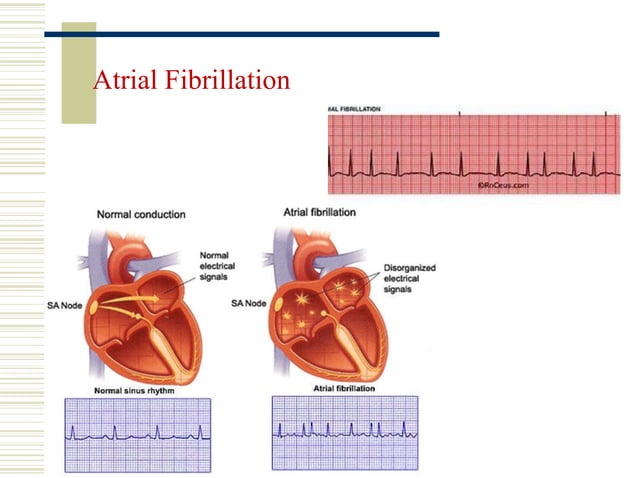 Wolff parkinson white syndrome | PPT