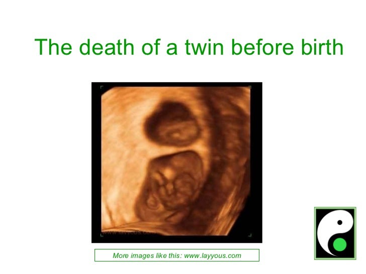 What Happens When One Twin Dies In The Second Trimester &ndash; LMKTZU