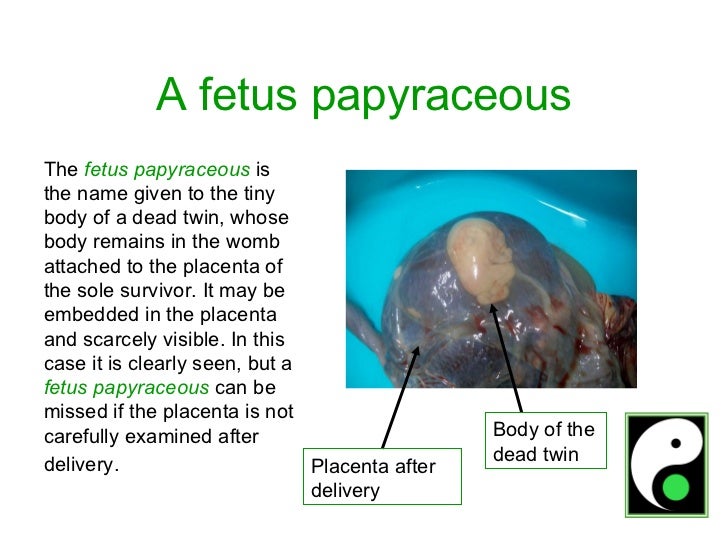 Womb Twin Survivors (1) Signs of a twin