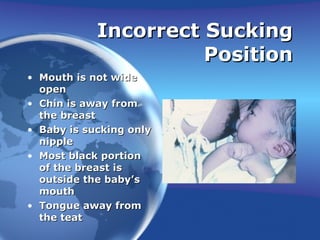 Incorrect Sucking Position Mouth is not wide open Chin is away from the breast Baby is sucking only nipple Most black portion of the breast is outside the baby’s mouth Tongue away from the teat 