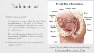 Endometriosis
What is endometriosis?	

• Endometriosis is present when the tissue that is
normally present in the lining of the uterus
(womb) occurs outside this layer and causes
pain and/or infertility. The lining layer is called
the endometrium.
• This layer of tissue is shed each month with
menstruation (period) or where a pregnancy
settles and grows.
• Most cases are caused by low progesterone/
sluggish pituitary.
http://www.endometriosisaustralia.org/
#!about-endometriosis/c15vm
 