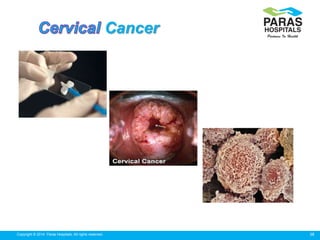 38Copyright © 2014 Paras Hospitals. All rights reserved.
Cancer
 