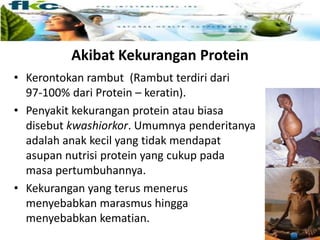 Akibat Kekurangan Protein
• Kerontokan rambut (Rambut terdiri dari
97-100% dari Protein – keratin).
• Penyakit kekurangan protein atau biasa
disebut kwashiorkor. Umumnya penderitanya
adalah anak kecil yang tidak mendapat
asupan nutrisi protein yang cukup pada
masa pertumbuhannya.
• Kekurangan yang terus menerus
menyebabkan marasmus hingga
menyebabkan kematian.
 