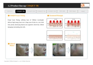 1.2 Product line-up COSJET TR

      QUEEN               COSJET TR             COSJET SR     COSJET VR       COSJET AR       PDT 608   PDT D662   oaze

       ■ COSJET Laser Toning                                                  ■ Treatment Principal

       Cosjet Laser Toning, utilizing laser of 1064nm wavelength,
       delivers high energy laser over a large area of skin in a very short
       time period, destroying hard-to-cure pigments selectively without
       damaging surrounding skin cells.




       ■ Clinical
         Photos




Copyrights© WONtechnology Co., Ltd. All Rights Reserved.
 