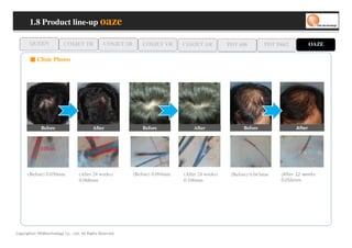 1.8 Product line-up oaze

       QUEEN              COSJET TR              COSJET SR       COSJET VR      COSJET AR          PDT 608        PDT D662                OAZE

       ■ Clinic Photos




              Before                       After                 Before             After                Before                 r etf A




      (Before) 0.030mm             (After 24 weeks)          (Before) 0.094mm   (After 24 weeks)    (Before) 0.043mm   s k e e w 2 1 r etf A(

                                   0.068mm                                      0.106mm                                m m 6 5 0. 0




Copyrights© WONtechnology Co., Ltd. All Rights Reserved.
 