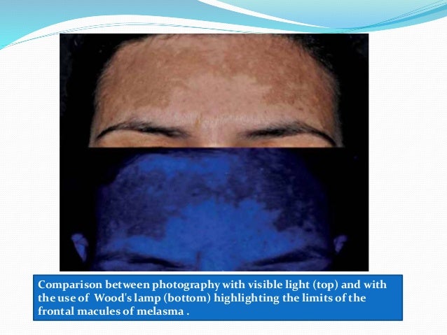 Wood’s Light In Dermatology