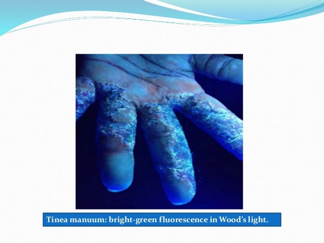 Wood’s Light In Dermatology