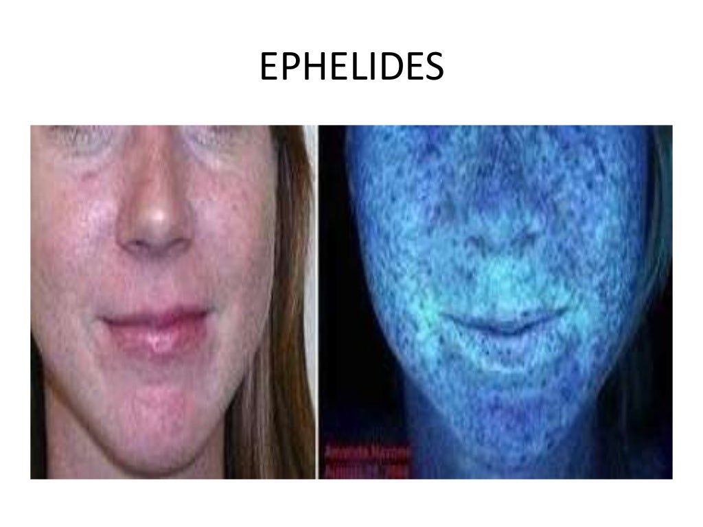 Wood's lamp by aseem