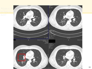 Where is t
he lung ca
ncer?
10
 