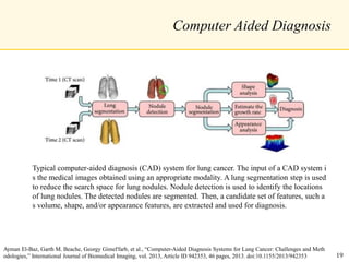 Computer Aided Diagnosis
Typical computer-aided diagnosis (CAD) system for lung cancer. The input of a CAD system i
s the medical images obtained using an appropriate modality. A lung segmentation step is used
to reduce the search space for lung nodules. Nodule detection is used to identify the locations
of lung nodules. The detected nodules are segmented. Then, a candidate set of features, such a
s volume, shape, and/or appearance features, are extracted and used for diagnosis.
Ayman El-Baz, Garth M. Beache, Georgy Gimel'farb, et al., “Computer-Aided Diagnosis Systems for Lung Cancer: Challenges and Meth
odologies,” International Journal of Biomedical Imaging, vol. 2013, Article ID 942353, 46 pages, 2013. doi:10.1155/2013/942353 19
 