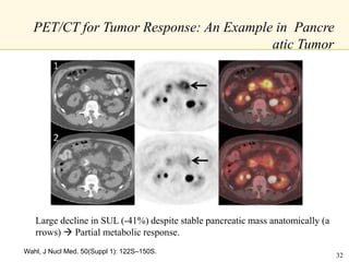 Wahl, J Nucl Med. 50(Suppl 1): 122S–150S.
Large decline in SUL (-41%) despite stable pancreatic mass anatomically (a
rrows)  Partial metabolic response.
PET/CT for Tumor Response: An Example in Pancre
atic Tumor
32
 