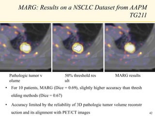 MARG: Results on a NSCLC Dataset from AAPM
TG211
Pathologic tumor v
olume
MARG results50% threshold res
ult
• For 10 patients, MARG (Dice = 0.69), slightly higher accuracy than thresh
olding methods (Dice = 0.67)
• Accuracy limited by the reliability of 3D pathologic tumor volume reconstr
uction and its alignment with PET/CT images 42
 
