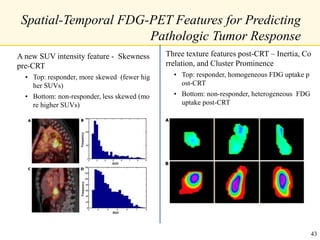 Spatial-Temporal FDG-PET Features for Predicting
Pathologic Tumor Response
A new SUV intensity feature - Skewness
pre-CRT
• Top: responder, more skewed (fewer hig
her SUVs)
• Bottom: non-responder, less skewed (mo
re higher SUVs)
Three texture features post-CRT – Inertia, Co
rrelation, and Cluster Prominence
• Top: responder, homogeneous FDG uptake p
ost-CRT
• Bottom: non-responder, heterogeneous FDG
uptake post-CRT
43
 