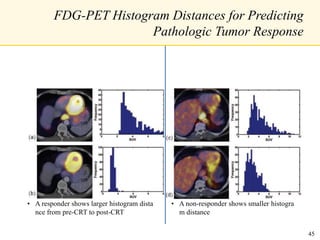 FDG-PET Histogram Distances for Predicting
Pathologic Tumor Response
• A responder shows larger histogram dista
nce from pre-CRT to post-CRT
• A non-responder shows smaller histogra
m distance
45
 