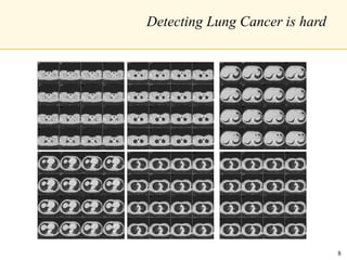 Detecting Lung Cancer is hard
8
 