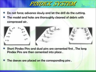 PINDEX SYSTEM
PINDEX SYSTEM
Do not force; advance slowly and let the drill do the cutting.
The model and holes are thoroughly cleaned of debris with
compressed air.
Short Pindex Pins and dual pins are cemented first , The long
Pindex Pins are then cemented into place .
The sleeves are placed on the corresponding pins .
 