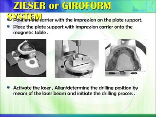 ZIESER or GIROFORM
ZIESER or GIROFORM
SYSTEM
SYSTEM
Position the carrier with the impression on the plate support.
Place the plate support with impression carrier onto the
magnetic table .
Activate the laser , Align/determine the drilling position by
means of the laser beam and initiate the drilling process .
 