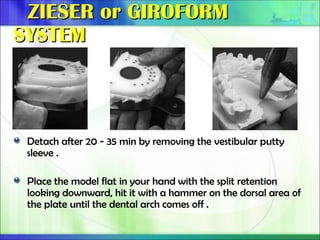 ZIESER or GIROFORM
ZIESER or GIROFORM
SYSTEM
SYSTEM
Detach after 20 - 35 min by removing the vestibular putty
sleeve .
Place the model flat in your hand with the split retention
looking downward, hit it with a hammer on the dorsal area of
the plate until the dental arch comes off .
 