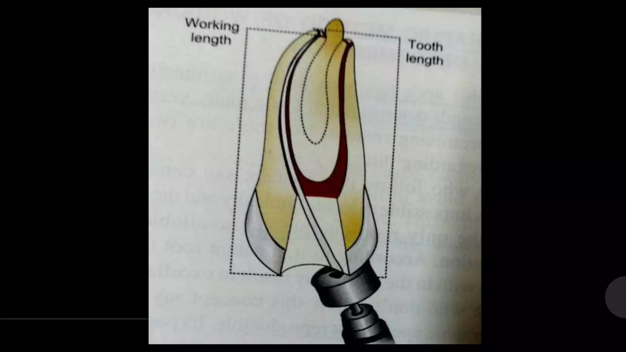 Working length Determination | PPTX