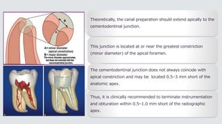 Theoretically, the canal preparation should extend apically to the
cementodentinal junction.
This junction is located at or near the greatest constriction
(minor diameter) of the apical foramen.
The cementodentinal junction does not always coincide with
apical constriction and may be located 0.5–3 mm short of the
anatomic apex.
Thus, it is clinically recommended to terminate instrumentation
and obturation within 0.5–1.0 mm short of the radiographic
apex.
 