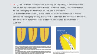 • 4 If, the foramen is displaced buccally or lingually, it obviously will
not be radiographically identifiable. In these cases, instrumentation
at the radiographic terminus of the canal will lead
to overinstrumentation , since there is a certain distance – which
cannot be radiographically evaluated – between the vertex of the root
and the apical foramen. This distance, measured by Dummer is
0.38mm
 