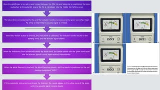If the endodontic instrument overshoots the foramen, the needle passes to the yellow zone of the scale,
while the acoustic signal remains steady
When the apical foramen is reached, the sound becomes steady, and the needle is positioned on the red
marking designated “APEX” .
When the endodontic file is advanced toward the apical third, the needle moves into the green zone again,
and the acoustic signal is once again emitted intermittently.
When the “Reset” button is pressed, the instrument is calibrated, the indicator needle returns to the
starting point, and the acoustic signal ceases.
The clip is then connected to the file, and the indicator needle moves toward the green zone (Fig. 15.21
A), while an intermittent acoustic signal is emitted.
Once the Apit/Endex is turned on and contact between the fifile clip and labial clip is established, the latter
is attached to the patient’s lip and the file is introduced into the middle third of the canal.
 