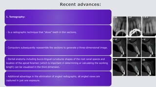Recent advances:
1. Tomography:
- Is a radiographic technique that “slices” teeth in thin sections.
- Computers subsequently reassemble the sections to generate a three-dimensional image.
- Dental anatomy including bucco-lingual curvatures shapes of the root canal spaces and
location of the apical foramen (which is important in determining or calculating the working
length) can be visualized in the third-dimension.
- Additional advantage in the elimination of angled radiographs; all angled views are
captured in just one exposure.
 