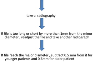 Working length determination | PPTX