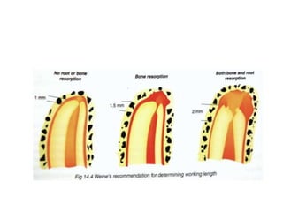 Working length determination | PPTX