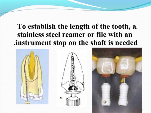 Working length determination | PPT