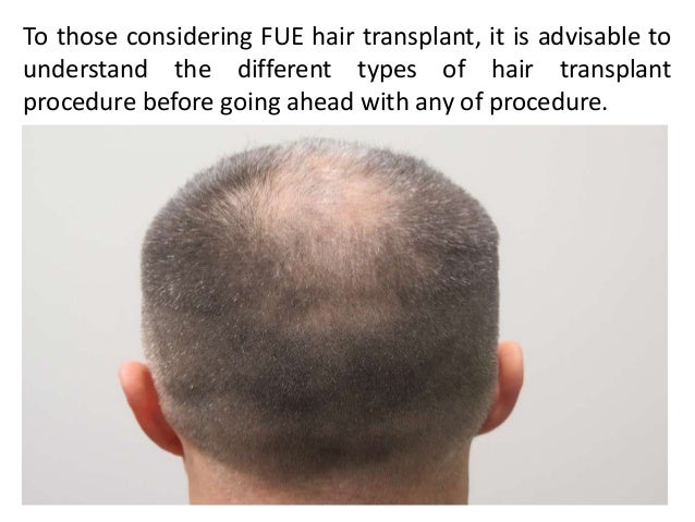 Working Of Fue Hair Transplant