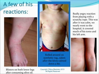 A few of his
reactions:
Copyright Tiffany Blackden 2013
All Rights Reserved
Blisters on both lower legs
after consuming olive oil.
Rolled around on
synthetic rug…taken
after the hives calmed
down a bit.
Really angry reaction
from playing with a
scratchy rope. This was
after it was calm, we
nearly went to the
hospital, it covered
much of his torso and
his left arm.
 