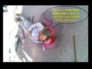 A portion
               lodged on
the victim right temple
   till his right chin
 