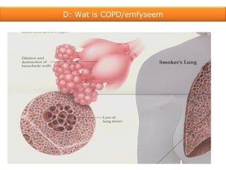 D: Wat is COPD/emfyseem 