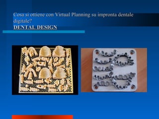 Cosa si ottiene con Virtual Planning su impronta dentaleCosa si ottiene con Virtual Planning su impronta dentale
digitale?digitale?
DENTAL DESIGNDENTAL DESIGN
 