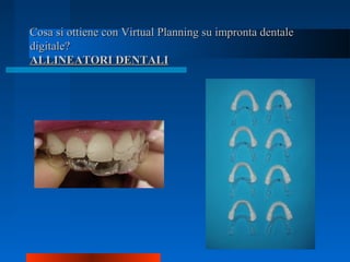 Cosa si ottiene con Virtual Planning su impronta dentaleCosa si ottiene con Virtual Planning su impronta dentale
digitale?digitale?
ALLINEATORI DENTALIALLINEATORI DENTALI
 