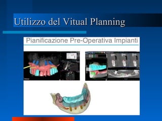 Utilizzo del Vitual PlanningUtilizzo del Vitual Planning
 