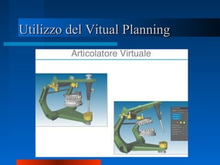 Utilizzo del Vitual PlanningUtilizzo del Vitual Planning
 