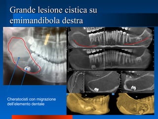 Grande lesione cistica suGrande lesione cistica su
emimandibola destraemimandibola destra
Cheratocisti con migrazione
dell’elemento dentale
 
