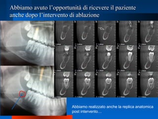 Abbiamo avuto l’opportunità di ricevere il pazienteAbbiamo avuto l’opportunità di ricevere il paziente
anche dopo l’intervento di ablazioneanche dopo l’intervento di ablazione
Abbiamo realizzato anche la replica anatomica
post intervento…
 