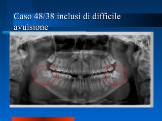Caso 48/38 inclusi di difficileCaso 48/38 inclusi di difficile
avulsioneavulsione
 