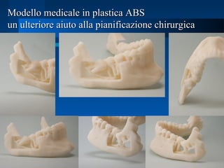 Modello medicale in plastica ABSModello medicale in plastica ABS
un ulteriore aiuto alla pianificazione chirurgicaun ulteriore aiuto alla pianificazione chirurgica
 