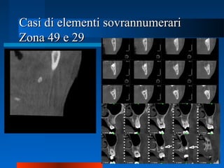 Casi di elementi sovrannumerariCasi di elementi sovrannumerari
Zona 49 e 29Zona 49 e 29
 