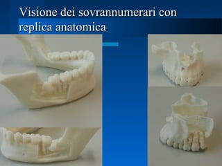Visione dei sovrannumerari conVisione dei sovrannumerari con
replica anatomicareplica anatomica
 