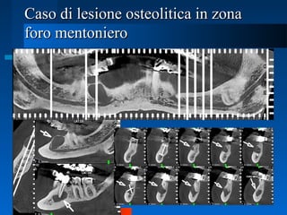 Caso di lesione osteolitica in zonaCaso di lesione osteolitica in zona
foro mentonieroforo mentoniero
 