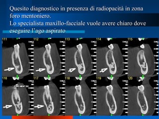 Quesito diagnostico in presenza di radiopacità in zonaQuesito diagnostico in presenza di radiopacità in zona
foro mentoniero.foro mentoniero.
Lo specialista maxillo-facciale vuole avere chiaro doveLo specialista maxillo-facciale vuole avere chiaro dove
eseguire l’ago aspiratoeseguire l’ago aspirato
 