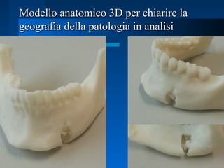 Modello anatomico 3D per chiarire laModello anatomico 3D per chiarire la
geografia della patologia in analisigeografia della patologia in analisi
 