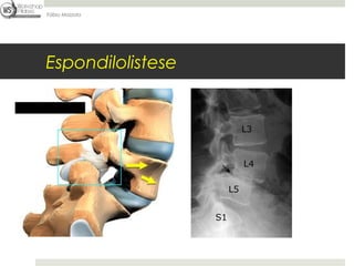 Fábio Mazzola




Espondilolistese
 