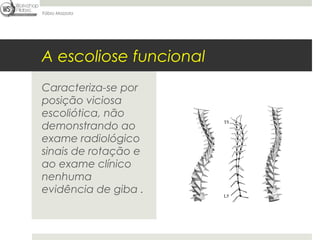 Fábio Mazzola




A escoliose funcional
Caracteriza-se por
posição viciosa
escoliótica, não
demonstrando ao
exame radiológico
sinais de rotação e
ao exame clínico
nenhuma
evidência de giba .
 