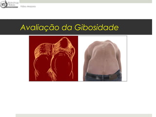 Fábio Mazzola




Avaliação da Gibosidade
 